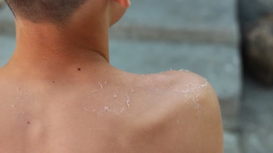 Güneş yanığı peeling cilt. Güneş yanığı gelen hasarlı cilt