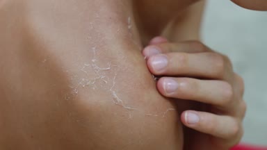 Peel güneş yanığı sonra cilt. Ölü dış deri tabakasının soyulması