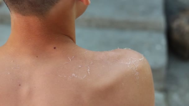 Peeling Der Haut Von Einem Sonnenbrand Beschädigte Haut Durch Einen — Stockvideo