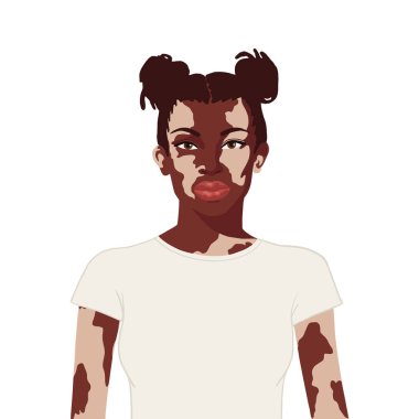 Beyaz arka planda vitiligo olan düz gerçekçi Afrikalı kadın.