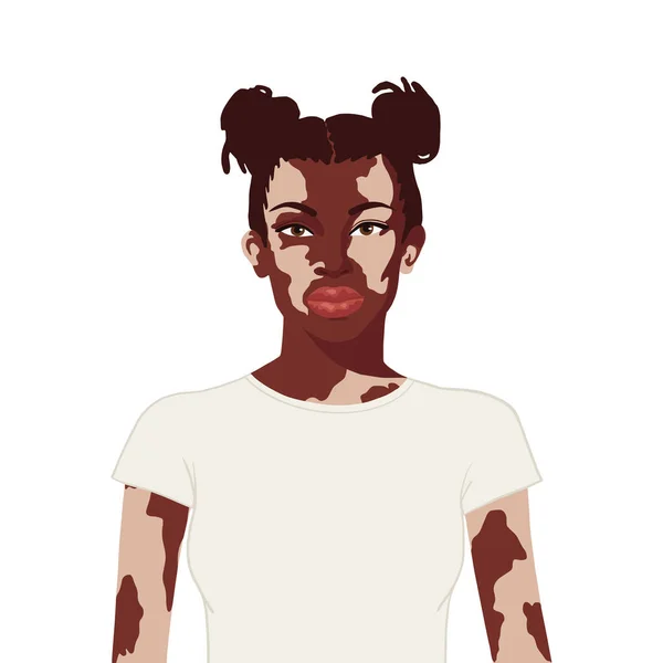 Mujer africana plana realista con vitiligo sobre fondo blanco — Archivo Imágenes Vectoriales