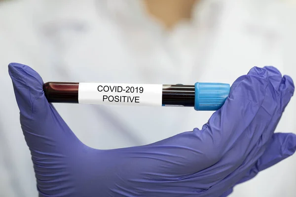 Tubo campione COVID-19 positivo. Diagnosi di laboratorio infezione coronavirica — Foto Stock