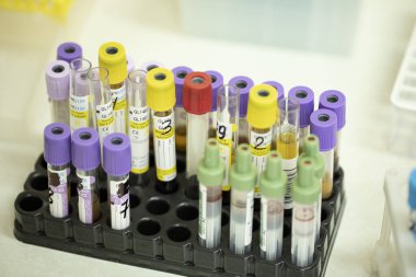 Kan örnekleri rafta. Laboratuvar, biyokimyasal analiz, HIV, AIDS, virüsler.