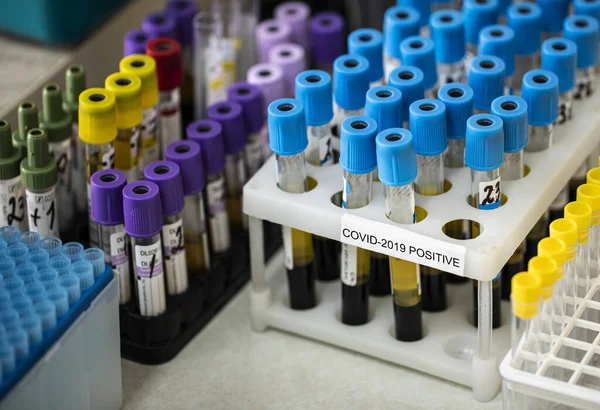 Κάτοχοι με σωλήνες δειγμάτων μολυσμένους από τον ιό της στομίου με θετικά αποτελέσματα — Φωτογραφία Αρχείου