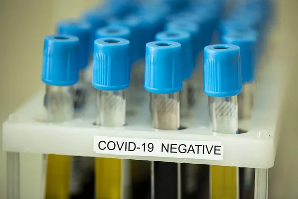 Κοντινό αρνητικό COVID-19 coronavirus εργαστηριακό δείγμα αιματολογικών εξετάσεων — Φωτογραφία Αρχείου