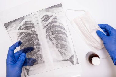 Ellerinde akciğer röntgeni ve beyaz yüz maskesi, zatürree ve bronşit konsepti olan bir doktor.