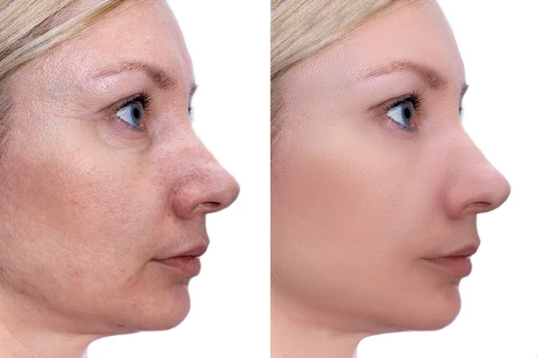 妇女在治疗前和治疗后的脸 生物修复 整容和色素斑 色素清除等美容过程年轻化的结果 — 图库照片
