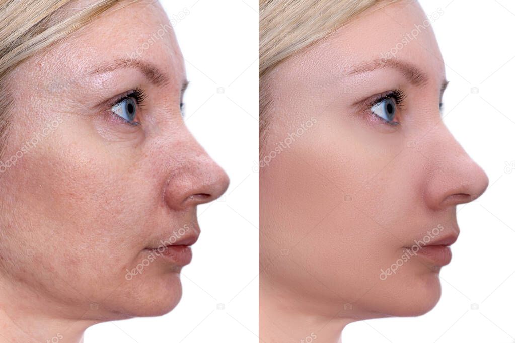 Woman face, before and after treatment - the result of rejuvenating cosmetological procedures of biorevitalization, face lifting and pigment spots, pigmentation removal.