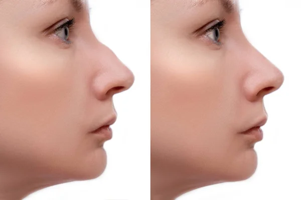 Mujer Joven Antes Después Rinoplastia Joroba Nasal Corrección Forma Sobre — Foto de Stock