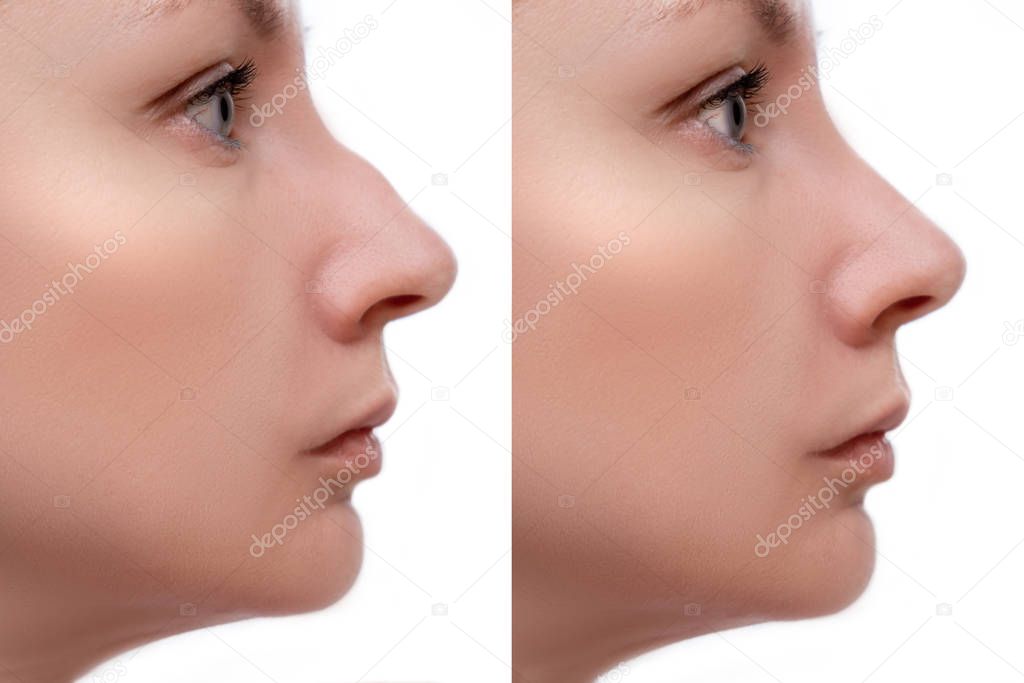 Young woman before and after rhinoplasty and nose hump, shape correction on white background, cosmetology and aesthetic surgery concept.