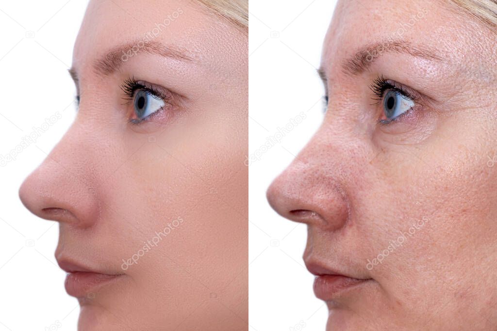 Woman face, before and after treatment - the result of rejuvenating cosmetological procedures of biorevitalization, face lifting and pigment spots, pigmentation removal.