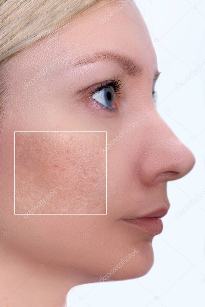 Face of a young woman with an accent on a skin enlarged pores and imperfections treatment, beauty treatment befire and after.