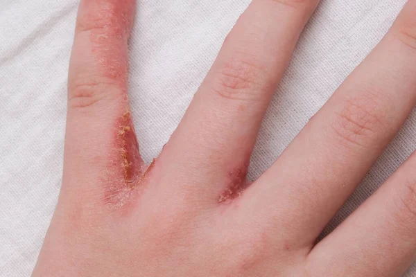 Gyermek Kéz Tanúja Ekcéma Atópiás Dermatitis Ujjak Között — Stock Fotó