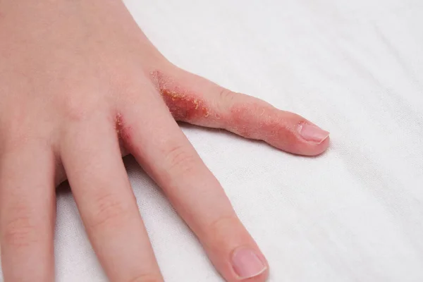 Kindliche Hand Mit Ekzemen Neurodermitis Zwischen Den Fingern — Stockfoto