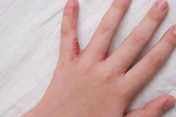 Παιδί Χέρι Witn Έκζεμα Ατοπική Δερματίτιδα Μεταξύ Των Δακτύλων — Φωτογραφία Αρχείου