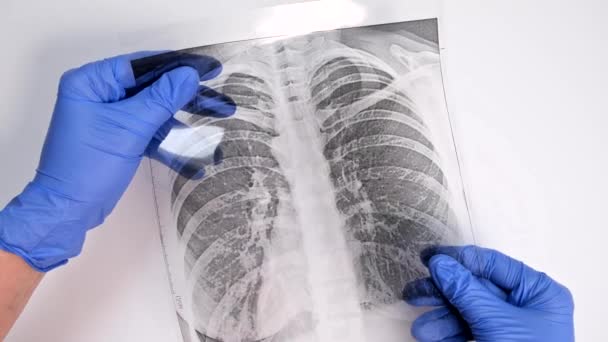 Hände Eines Arztes Blauen Handschuhen Untersuchen Fluorographie Röntgen Eines Patienten — Stockvideo