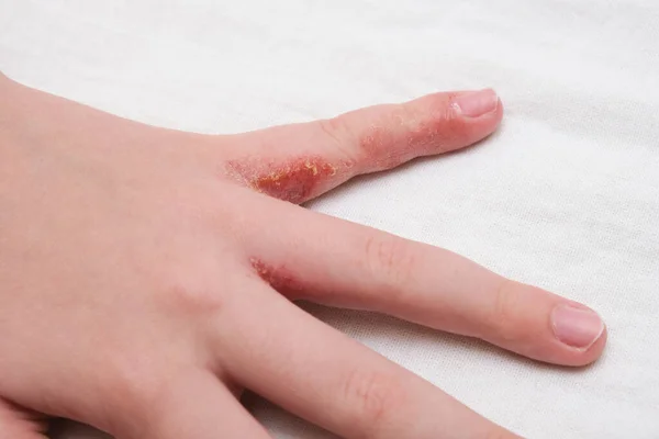 Niño Mano Witn Eczema Dermatitis Atópica Entre Los Dedos — Foto de Stock