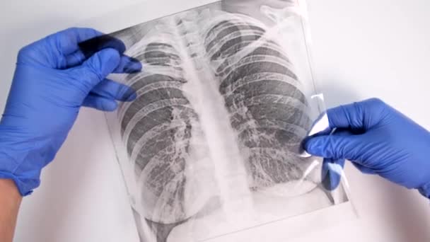 Hände eines Arztes in blauen Handschuhen untersuchen, Fluorographie, Röntgen eines Patienten und Daumen nach unten zeigen während Epidemie, Lungenentzündung und Bronchitis Behandlung und Diagnostik — Stockvideo