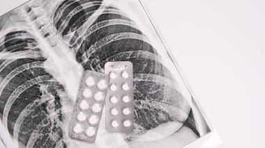 Fluorography, x-ray and different pills in blisters falling on it on white background, pneumonia and bronchitis treatment and diagnostic. clipart