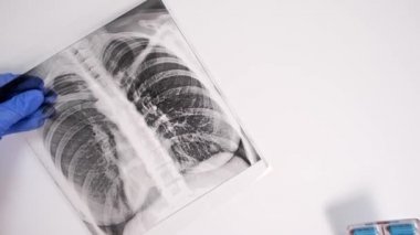 Mavi eldivenli bir doktorun elleri antibiyotik, enfeksiyona karşı ilaç, florografi, fırında röntgen, zatürree ve bronşit tedavisi ve epidemi sırasında hastanın teşhisini gösteriyor.