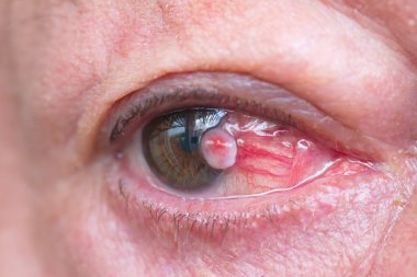 Close up of the eye conjunctival squamous cell carcinoma clipart