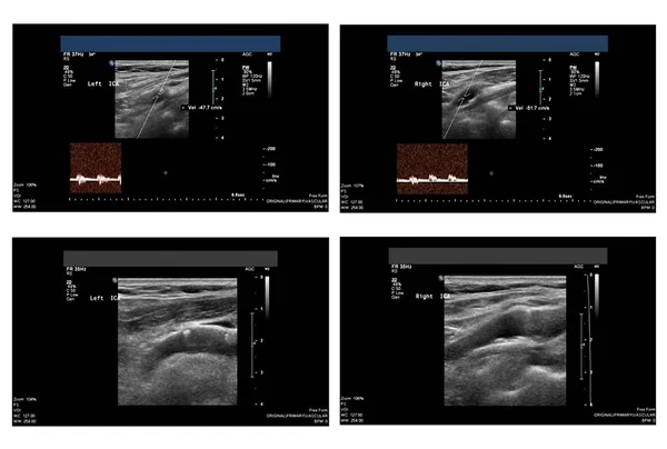 Ultrason resmini Karotid arter — Stok fotoğraf