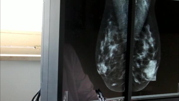 コンピューターで患者の女子乳がん研究の結果. — ストック動画