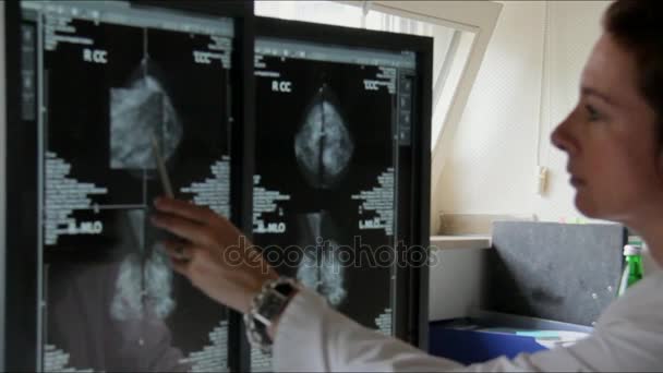 Ung kvinna läkare undersöker patienten Famale Breast Cancer forskningsresultat på datorn — Stockvideo