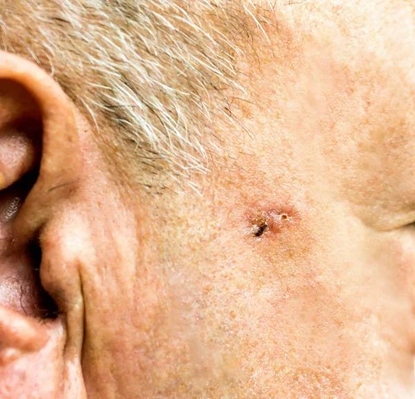 Ameliyattan önce yaşlı adamın yüzünde Hücre Karsinomu