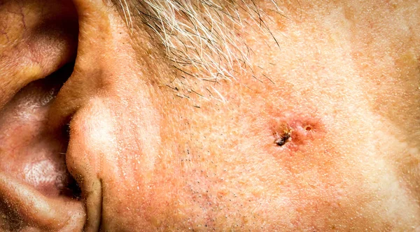 Cell Carcinoma on the face of older man before surgery