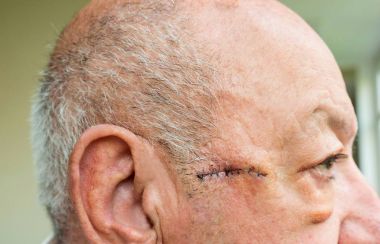 Close-up of elderly man face with edema after surgery clipart