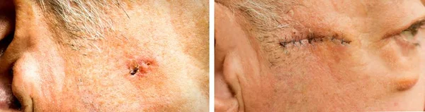 Carcinoma basocellulare sul viso dell'uomo più anziano prima e dopo l'intervento chirurgico — Foto Stock