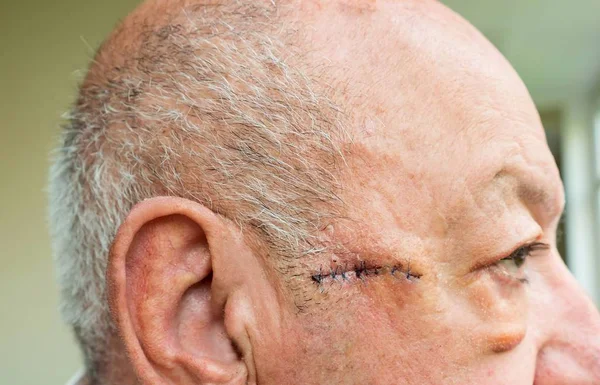 Close-up of elderly man face with edema after surgery — Stock Photo, Image