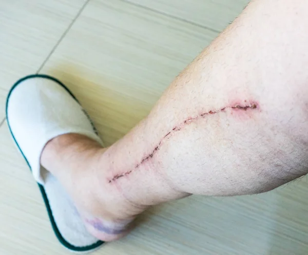 Focus selettivo della gamba umana maschile con cicatrice da chirurgia cardiaca della malattia coronarica — Foto Stock