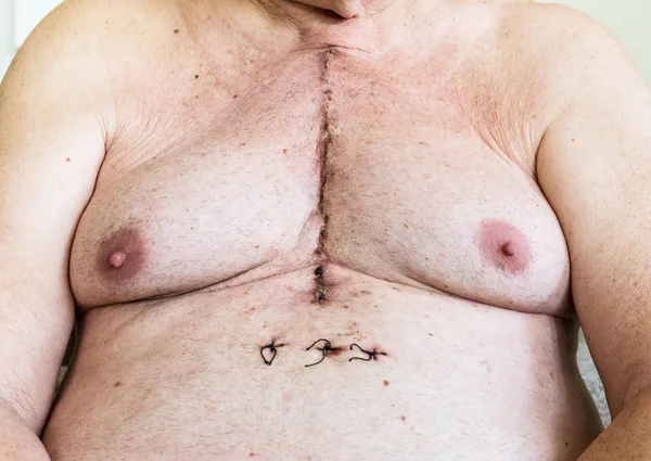 Surgical scar from cardiac surgery of coronary artery disease