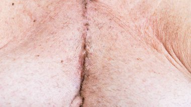 Koroner arter hastalığı kalp cerrahisi ameliyat izi