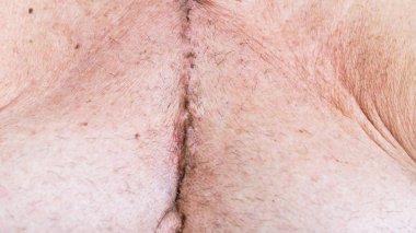 Koroner arter hastalığı kalp cerrahisi ameliyat izi