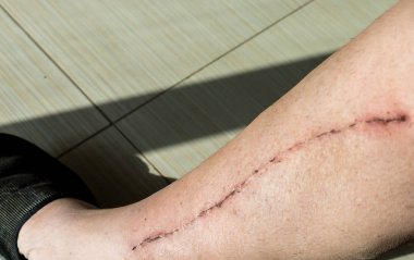 Yara izi koroner arter hastalığı kalp cerrahisi ile selektif erkek insan odak bacak