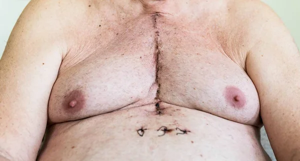 Surgical scar from cardiac surgery of coronary artery disease