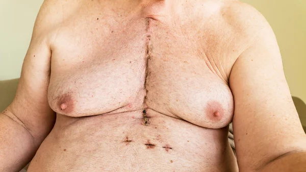 Surgical scar from cardiac surgery of coronary artery disease