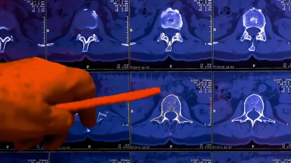 Doctor Analyseert Resultaten Van Computer Tomografie Beeldvorming Van Patiënt Wervelkolom — Stockfoto