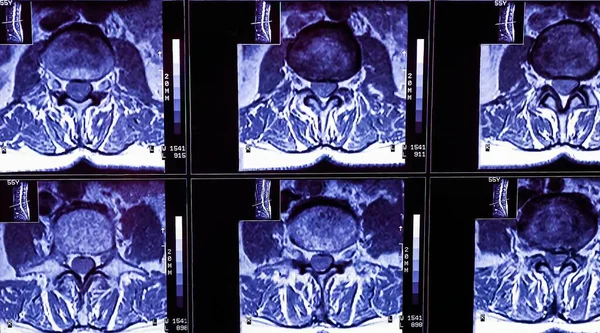 Магнітно Резонансна Томографія Хребта Пацієнта Хронічним Болем Спині Mri Демонструє — стокове фото