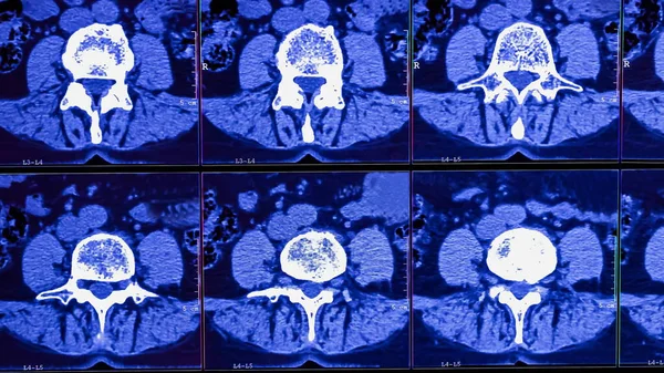 医生分析了慢性背痛患者脊柱计算机断层扫描的结果 显示脊柱退变 腰椎间盘突出和神经根压 — 图库照片