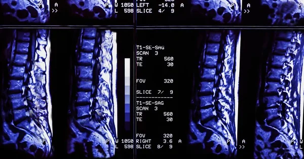 Results of magnetic resonance imaging of a patient spine with chronic back pain. The MRI shows degenerative changes of spines, lumbar discs herniation and nerve roots compression.