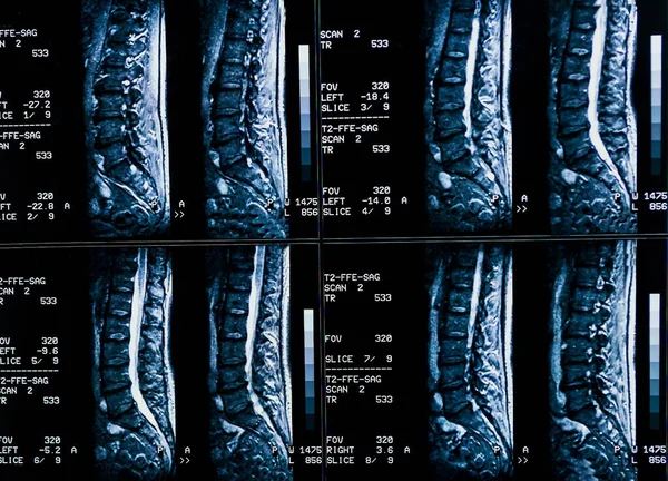 Magnetic Resonance Imaging Patient Spine Chronic Back Pain Mri Shows — Stock Photo, Image