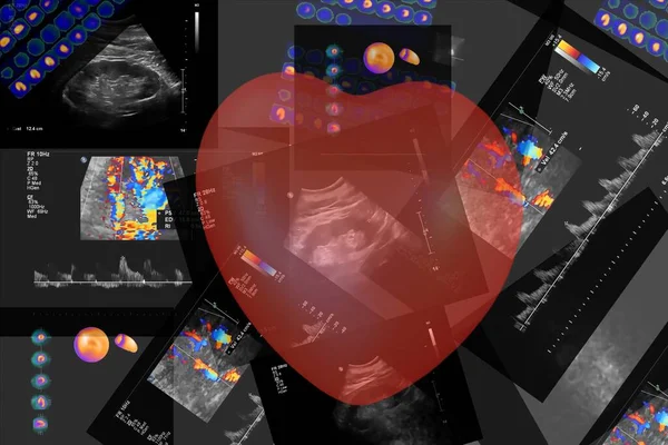 Kontrastlı Sıvı Stres Kullanarak Kalp Koroner Damarların Koroner Tomografi Anjiyografisi — Stok fotoğraf