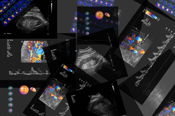 Koronar Datortomografi Angiografi Ccta Hjärtat Och Kranskärlen Med Hjälp Kontrastvätska — Stockfoto