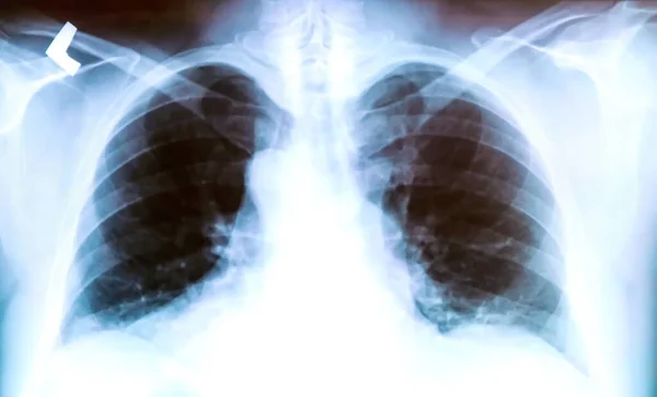 炎症プロセスの顕著な痕跡を持つ患者の肺のX線 — ストック写真