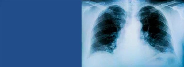 青い背景に炎症過程の顕著な痕跡を持つ患者の肺のX線 — ストック写真