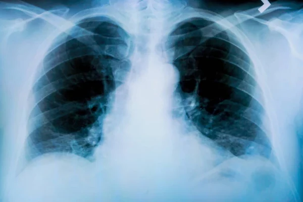 炎症プロセスの顕著な痕跡を持つ患者の肺のX線 — ストック写真